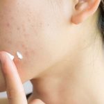 Top 10 Kem trị mụn an toàn cho da