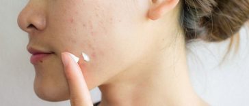 Top 10 Kem trị mụn an toàn cho da