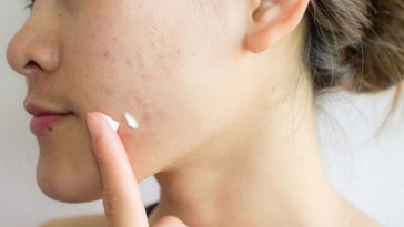 Top 10 Kem trị mụn an toàn cho da